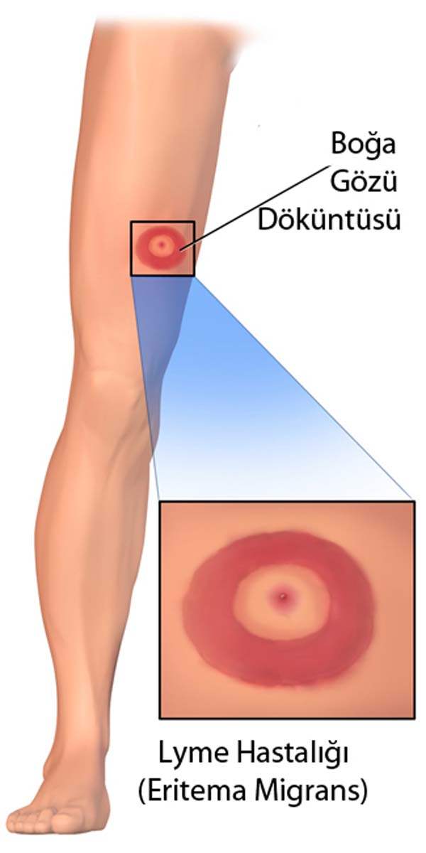 Hamilelik ve Lyme Hastalığı