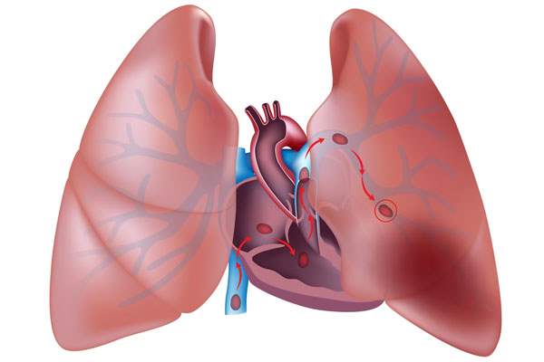 Ölçülü doz inhaler nedir?