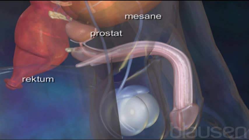 Prostat Alımı