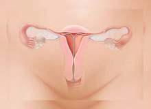 Endometriyoz - Neler Olur?