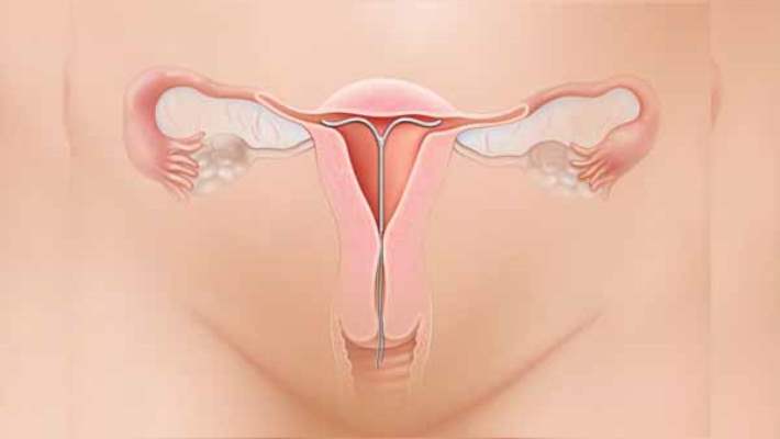 Endometriyoz - Neler Olur?