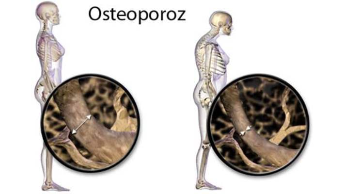 Osteoporozla İlgili Hurafeler