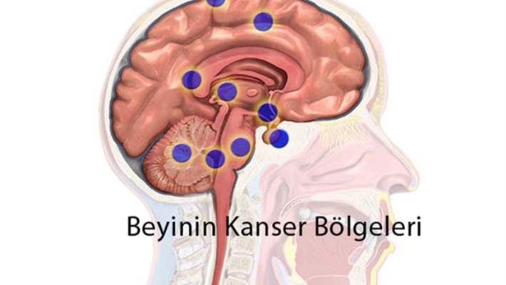 Beyin Kanseri Tedavisinde Yeni Yöntem