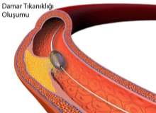 Damar rahatsızlıklarında uygulanan tedaviler