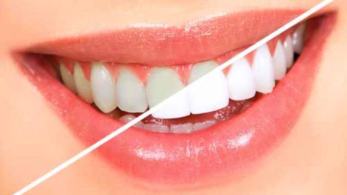 Dişlerin Renklenmesine Yol Açan Faktörler Nelerdir?