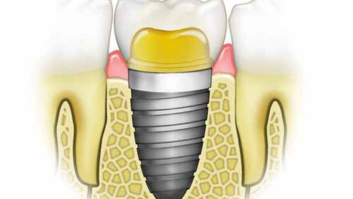 Diş İmplantlarında Yan Etki Görülür Mü?