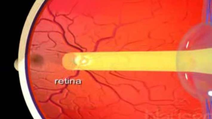 Retina Yırtığı