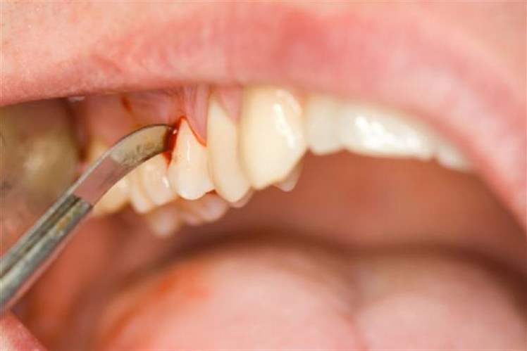 Diş Eti Hastalığı (Periodontal) Hemen Sağlık