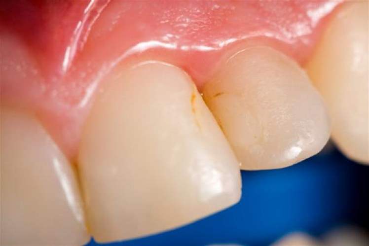 Diş Eti Hastalığı (Periodontal) Hemen Sağlık