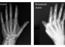 Romatoid Artrit için El Egzersizleri