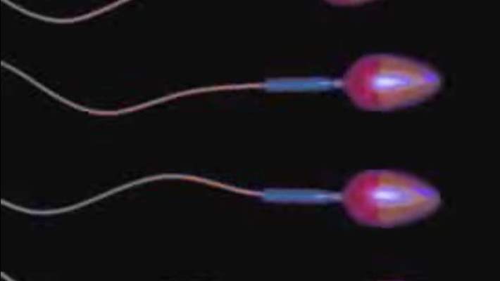 Spermatosel (Epididimal Kist)