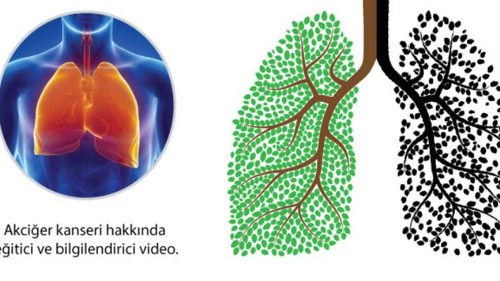 İnflamatuar Göğüs Kanseri Nasıl Teşhis Edilir?